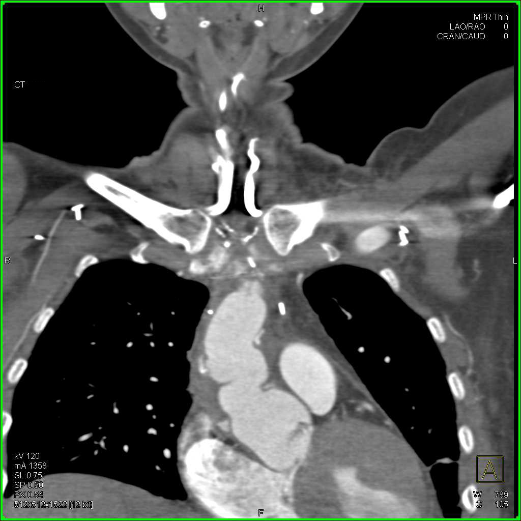 Repair of Type A Dissection - CTisus CT Scan