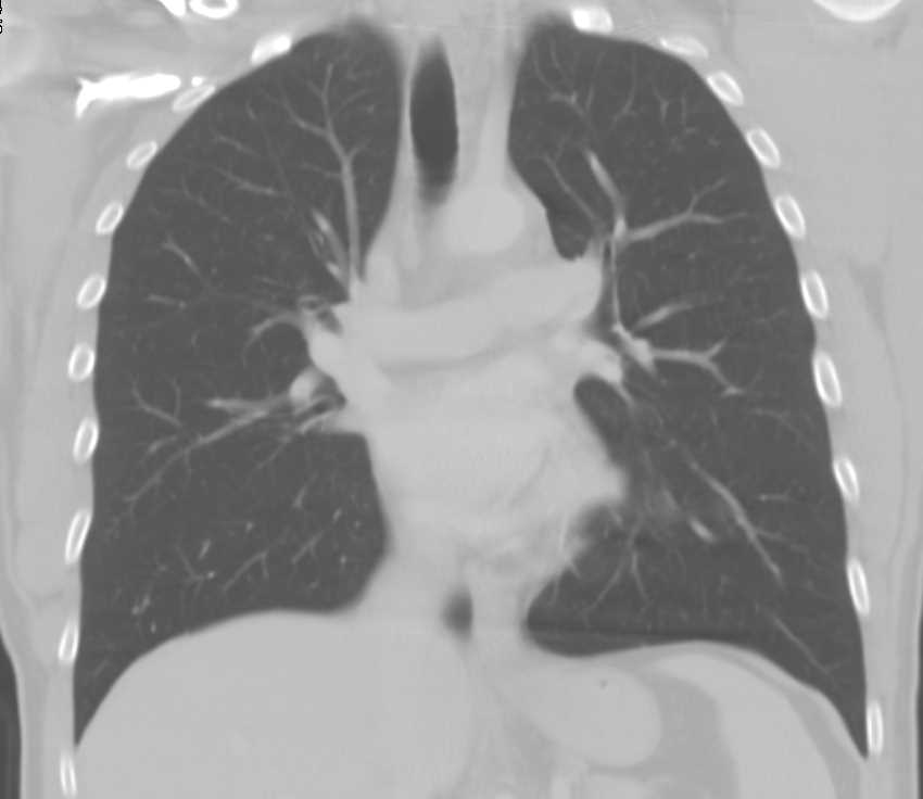 Cystic Thymoma - CTisus CT Scan