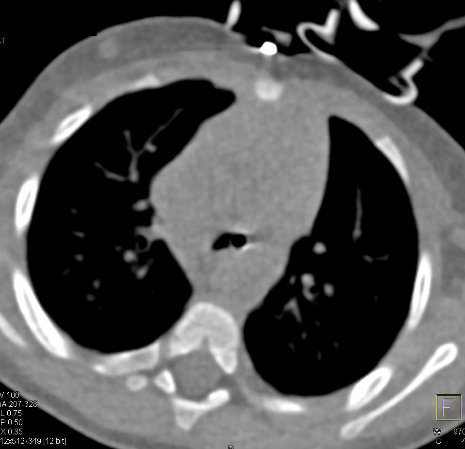 Tracheal Stenosis at the Tracheal Bifurcation - CTisus CT Scan