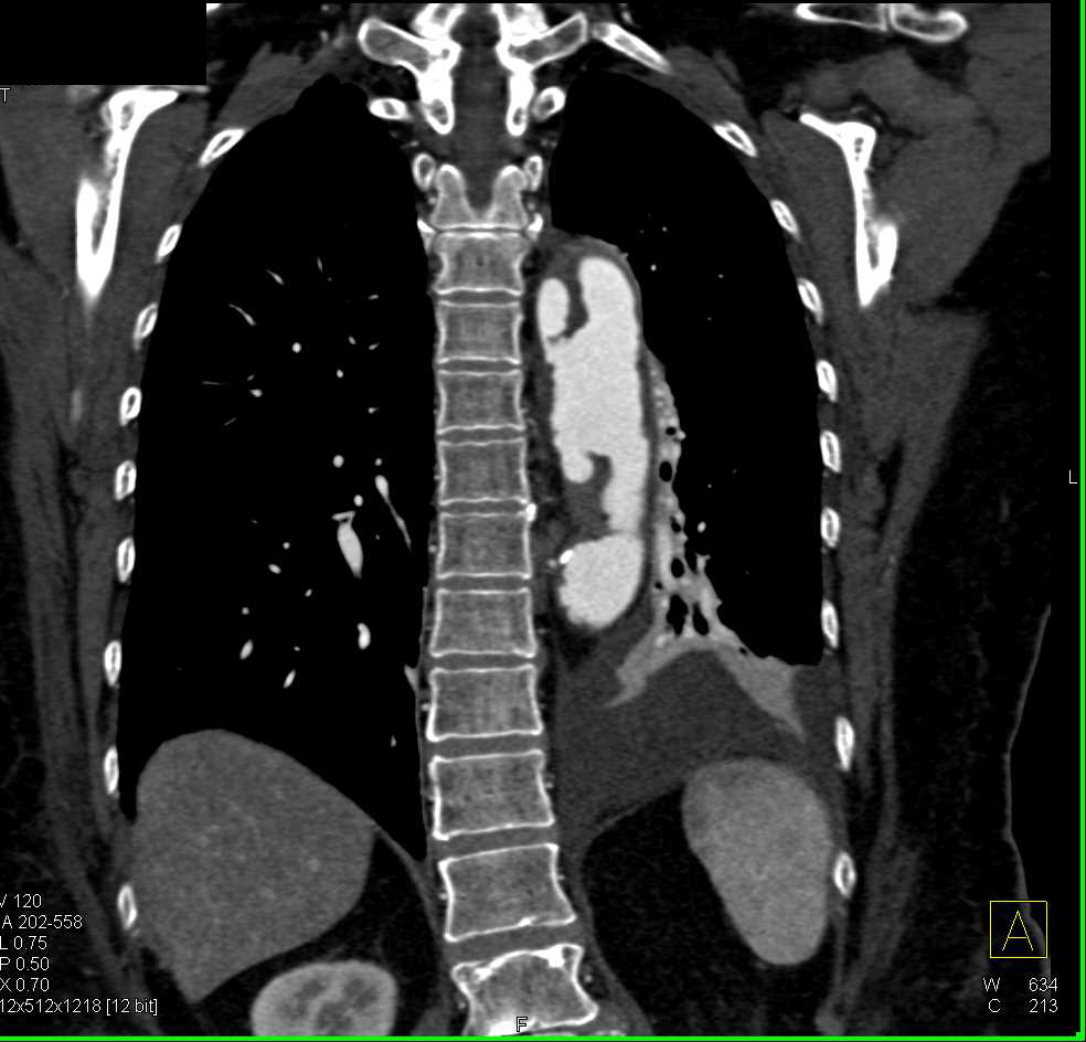 Large Ulcerations Descending Thoracic Aorta - CTisus CT Scan