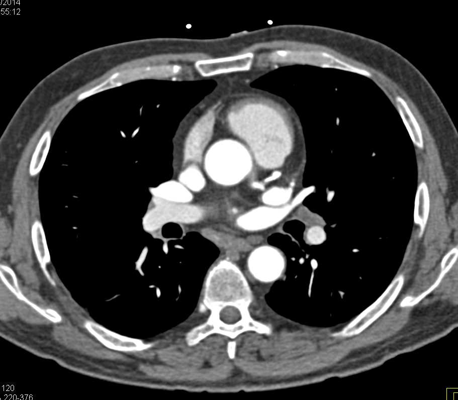 Incidental Lung Cancer in Patient Evaluation for Suspected Coronary Artery Disease - CTisus CT Scan
