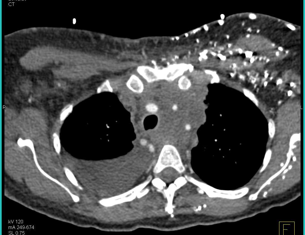 Superior Vena Cava (SVC) Syndrome due to Non-Small Cell Lung Cancer (NSCLC) with Hot Spot in the Liver - CTisus CT Scan