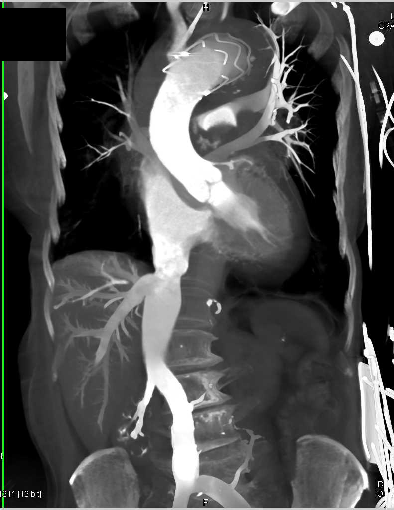 Type A Dissection with Mediastinal Bleed and Stent in Descending Aorta - CTisus CT Scan