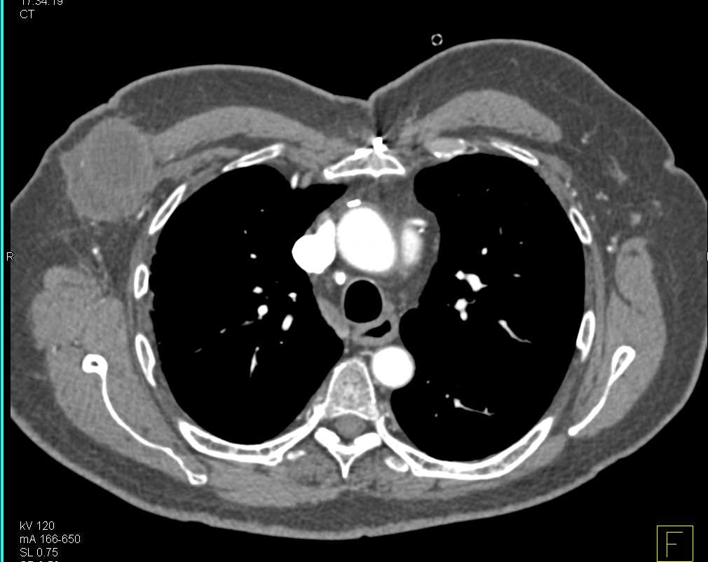 Carcinoma of the Right Breast - CTisus CT Scan