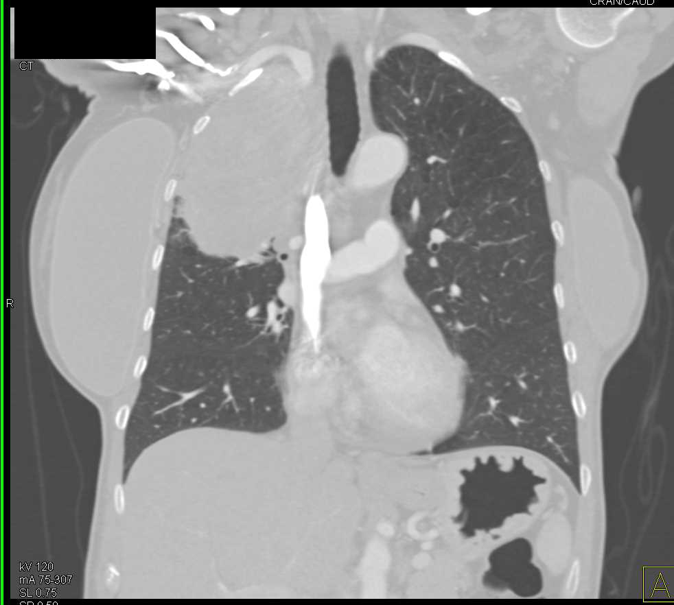 Neurogenic Sarcoma Right Chest And Chest Wall Chest Case Studies
