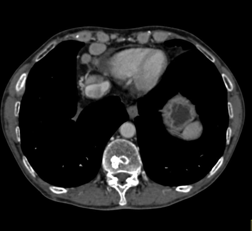 Paracardiac Adenopathy - CTisus CT Scan