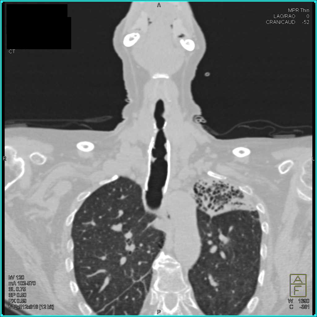Stent in Airway with Traction Bronchiectasis Left Upper Lung - CTisus CT Scan
