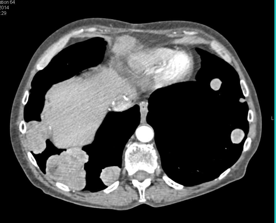 Carcinoma of the Tail of the Pancreas with Lung Metastases - CTisus CT Scan