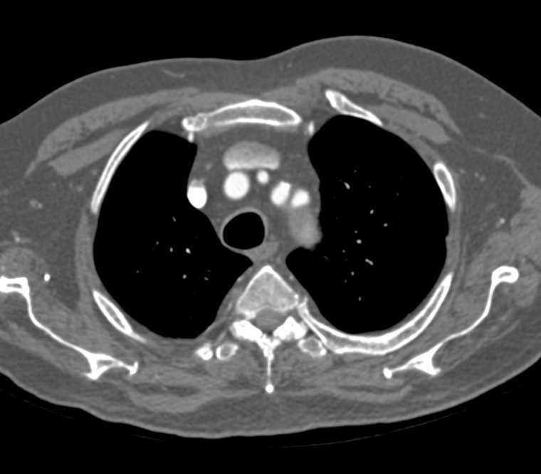 Plaque in Thoracic Aorta - CTisus CT Scan