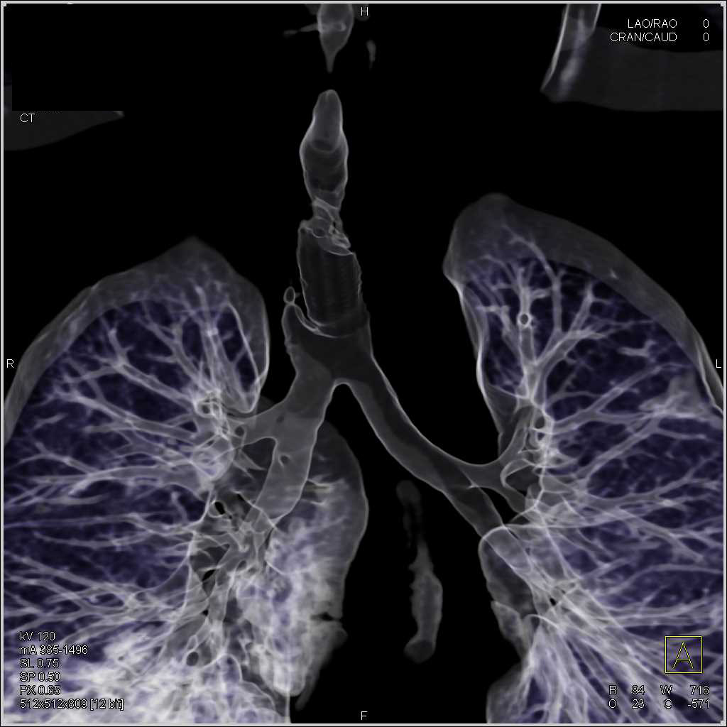 Stent in Trachea in 3D with Tracheal Stenosis - Chest Case Studies