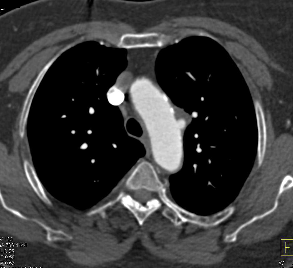 Ulceration in Thoracic Aorta - CTisus CT Scan