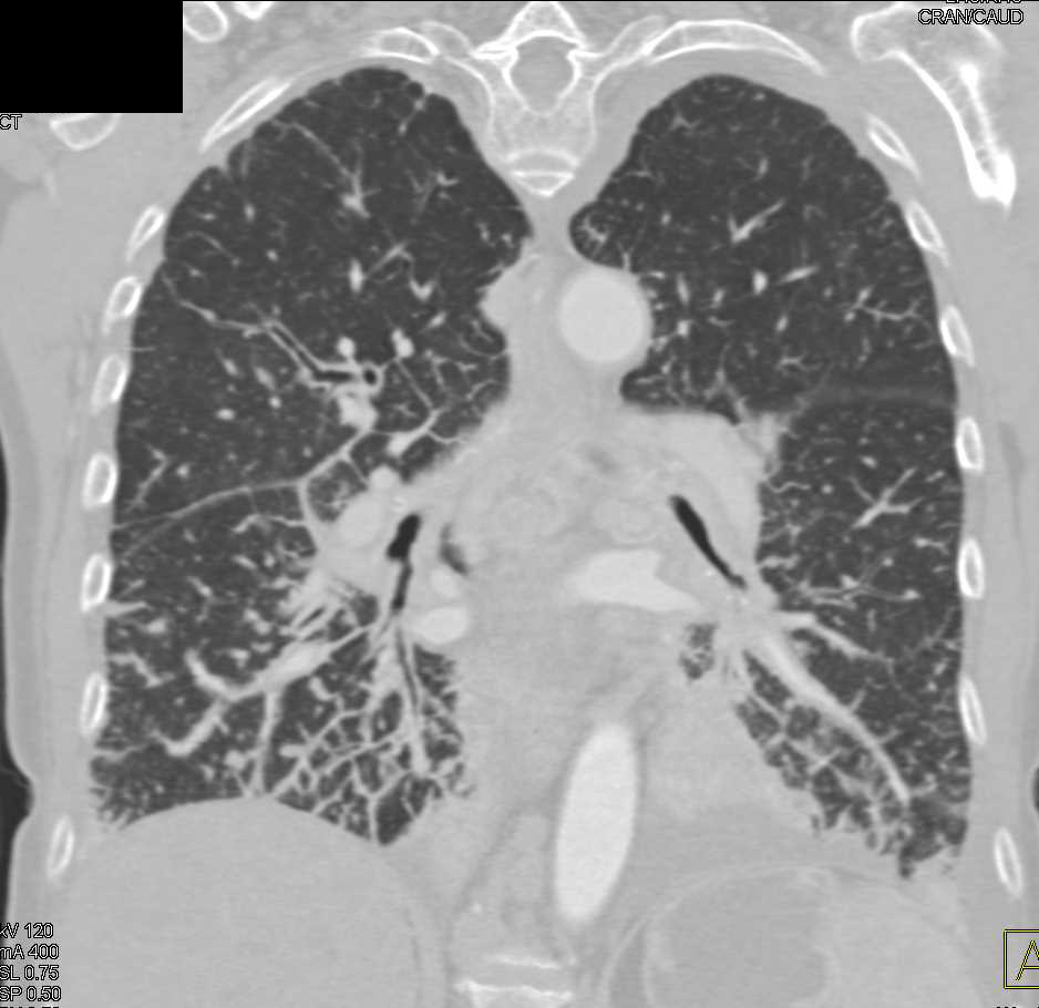 Lymphangitic Spread due to Lung Cancer - Chest Case Studies - CTisus CT