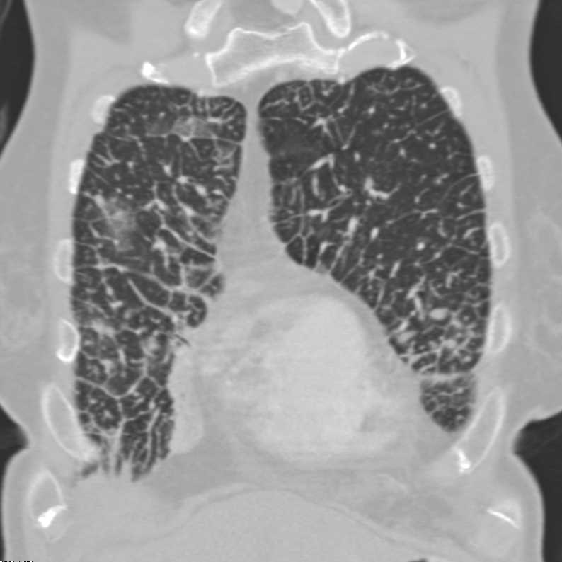 Lymphangitic Spread due to Lung Cancer - CTisus CT Scan