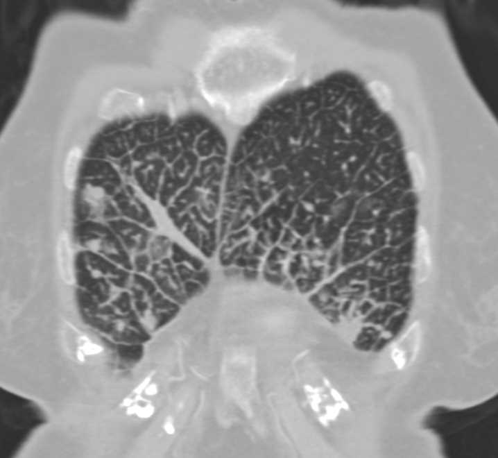 Lymphangitic Spread due to Lung Cancer - Chest Case Studies - CTisus CT