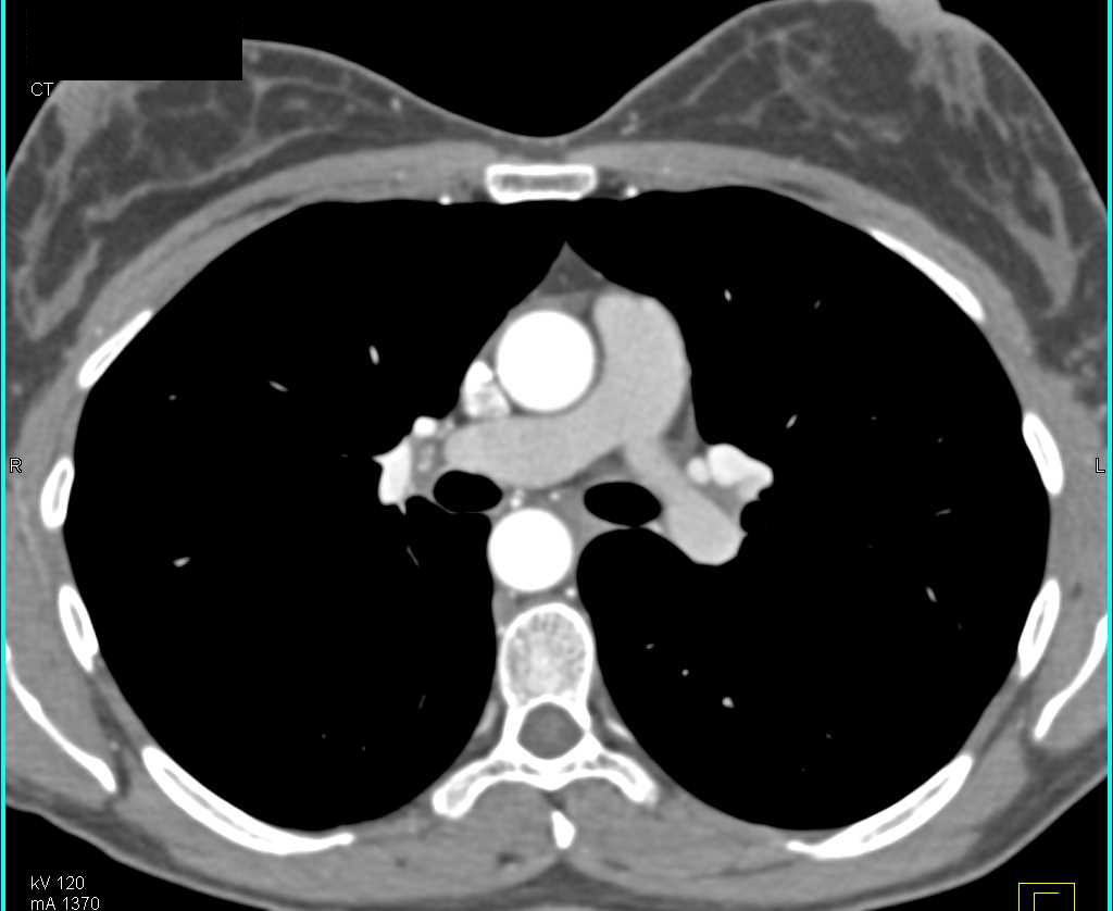 Right Aortic Arch - CTisus CT Scan