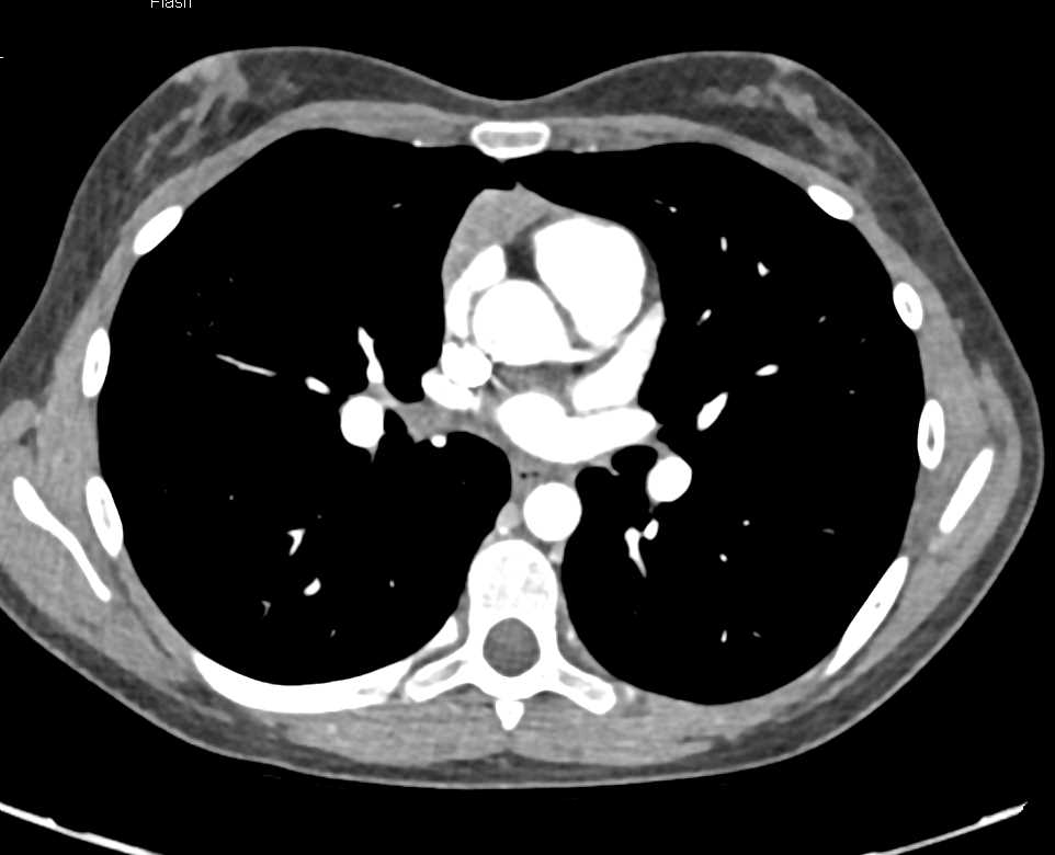 Multiple Pulmonary Arteriovenous Malformations (PAVMs) - CTisus CT Scan