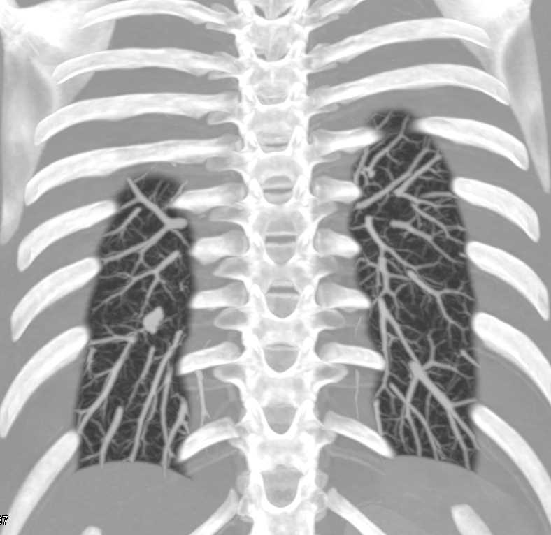 Multiple Pulmonary Arteriovenous Malformations (PAVMs) - CTisus CT Scan