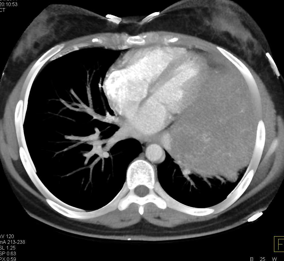 Lymphoma Left Chest Involves the Heart - CTisus CT Scan