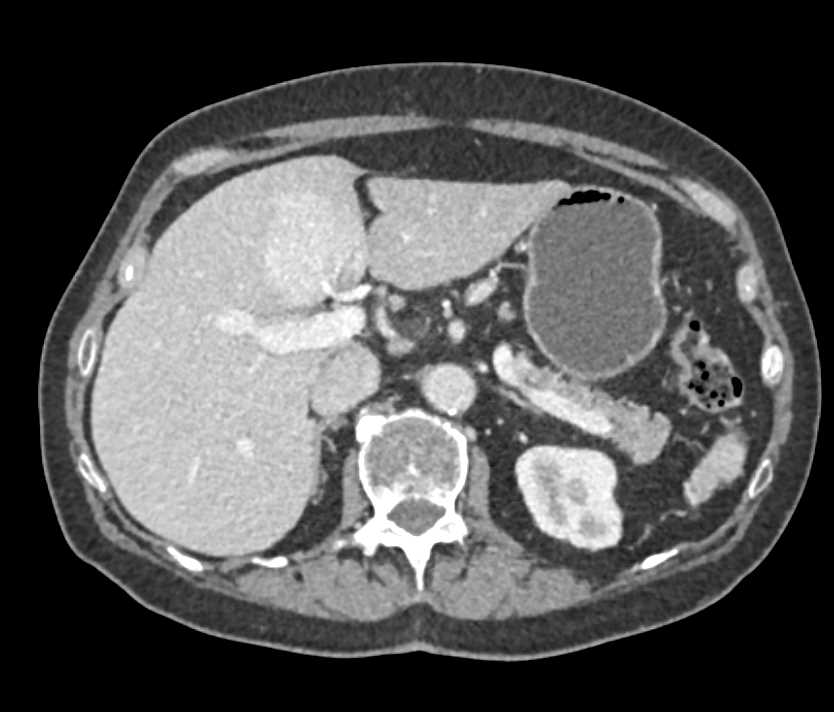 Cardiac Lymphoma with Multiple Satellite Lesions - CTisus CT Scan