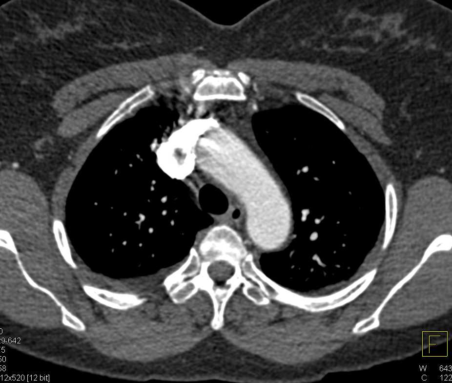 Pseudo clot in the Superior Vena Cava (SVC) - CTisus CT Scan