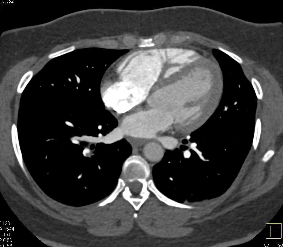 Pulmonary Embolism Right Lower Lobe - CTisus CT Scan