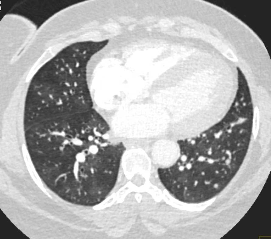 Pulmonary Nodules Best Seen on MIP Imaging - CTisus CT Scan