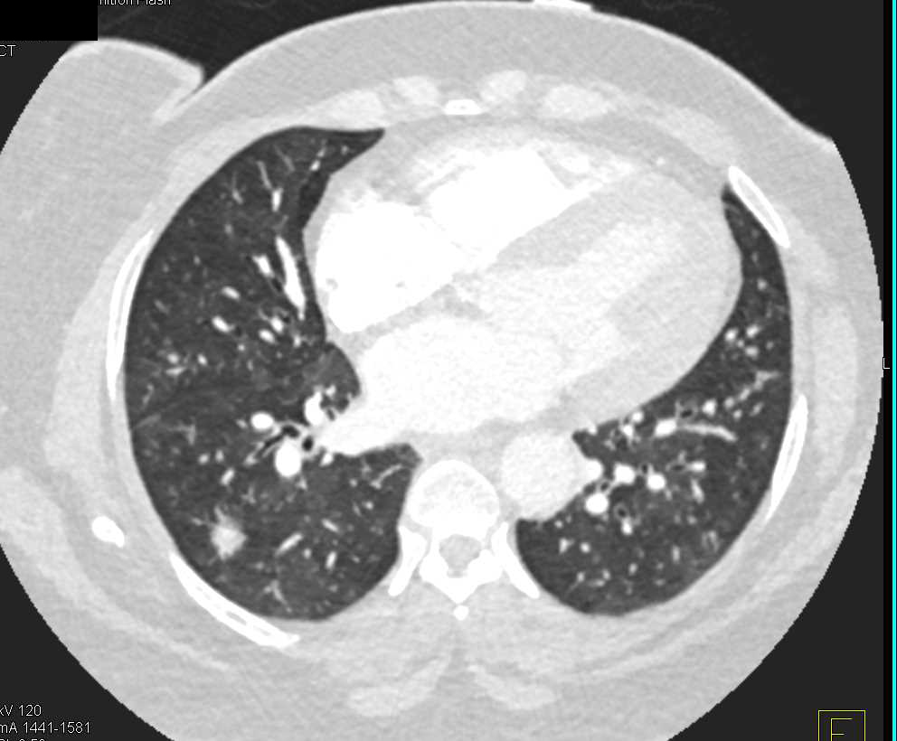 Pulmonary Nodules Best Seen on MIP Imaging - CTisus CT Scan