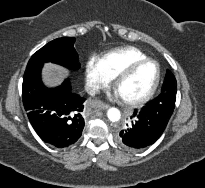 Intramural Hematoma Descending Thoracic Aorta with Posterior Mediastinal Bleed - CTisus CT Scan