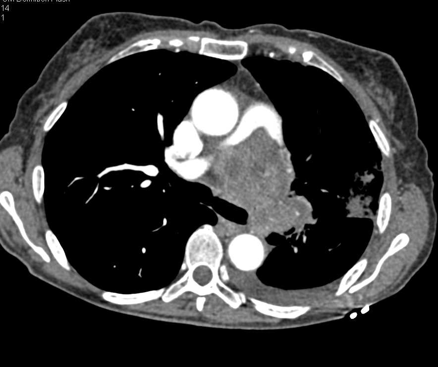 Pulmonary Artery Sarcoma - CTisus CT Scan