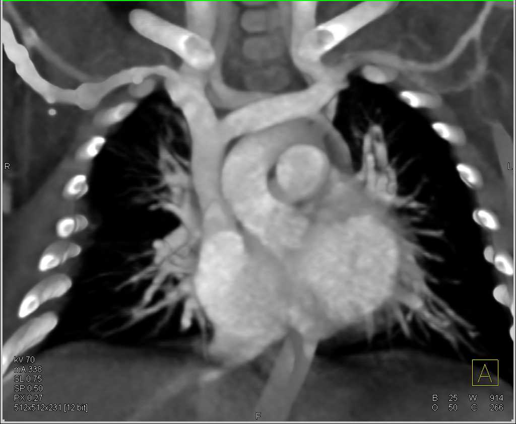 Normal Superior Vena Cava (SVC) in 3D - CTisus CT Scan