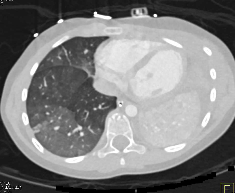 Occluded Left Mainstem Bronchus in 3D - CTisus CT Scan