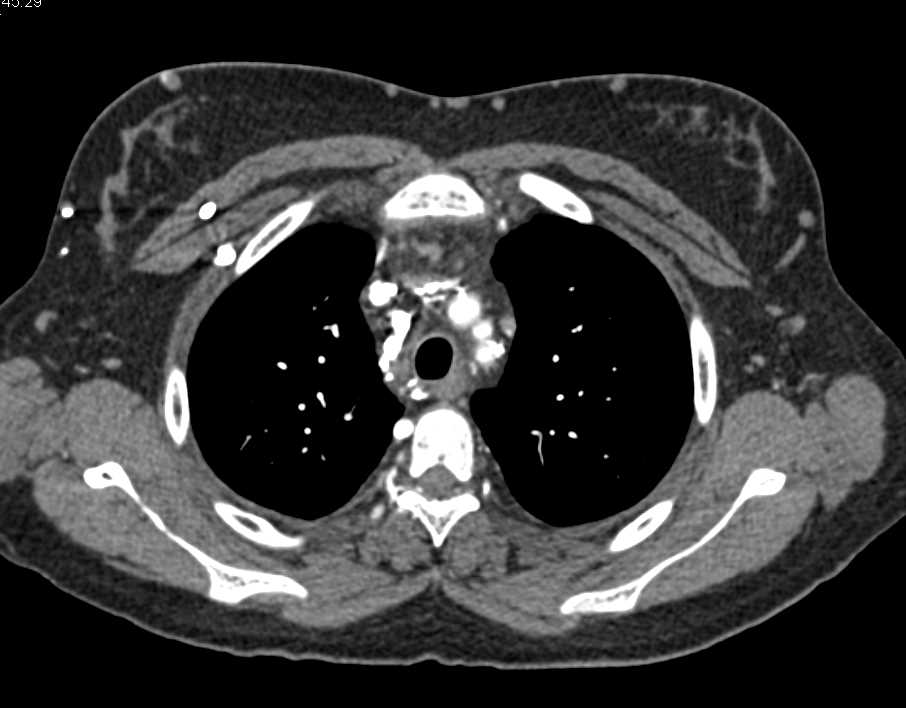 Superior Vena Cava (SVC) Syndrome with Multiple Collaterals in Chest Wall and Abdomen - CTisus CT Scan