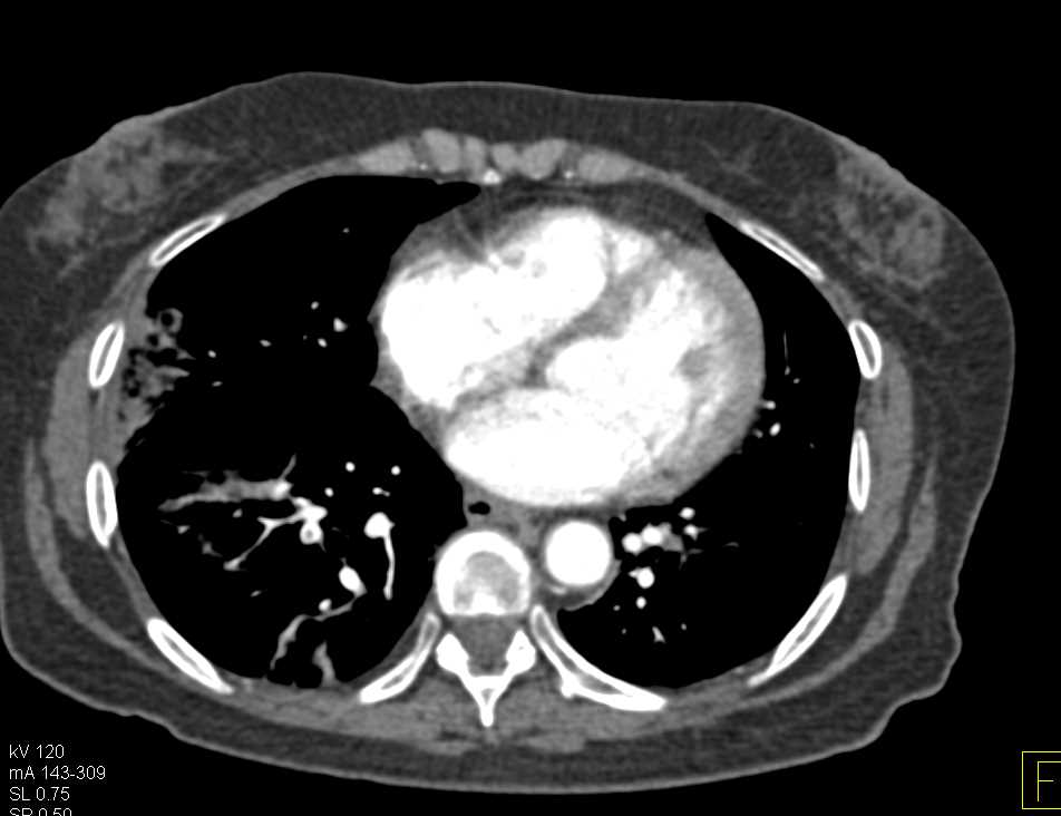Incidental Right Deep Vein Thrombosis (DVT) with Pulmonary Embolism in Patient with Colon Cancer - CTisus CT Scan