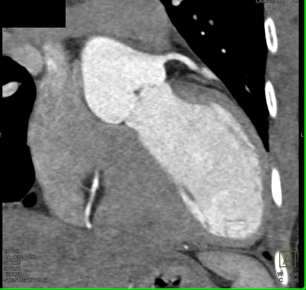 Pectus Deformity and Sacral Dural Ectasia in a Marfan Patient - CTisus CT Scan