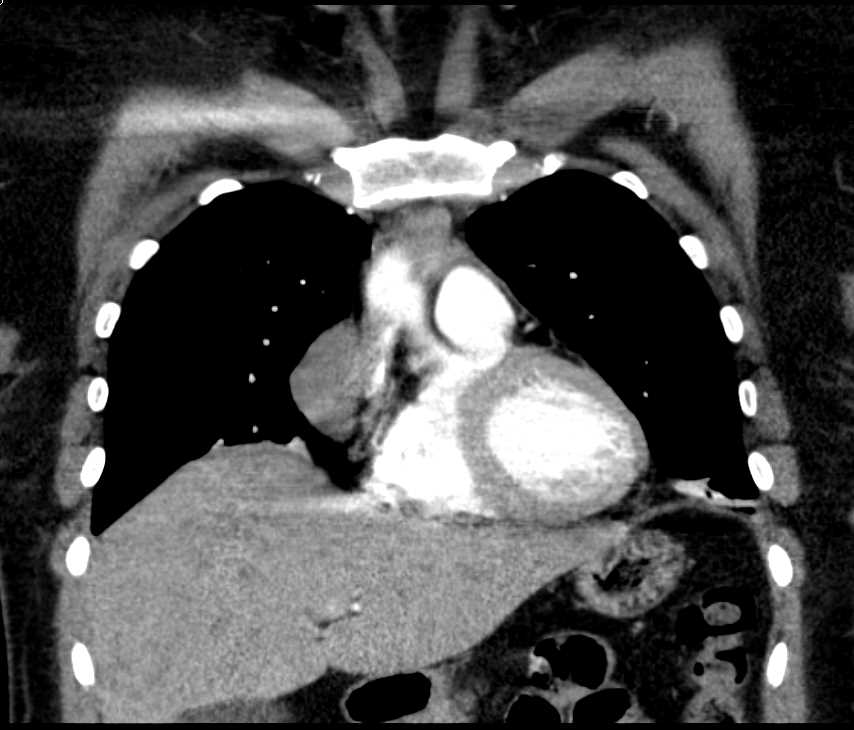 Thymoma - CTisus CT Scan