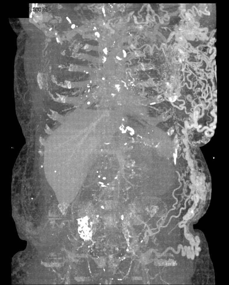 Occluded Left Innominate Vein with Multiple Collaterals - CTisus CT Scan