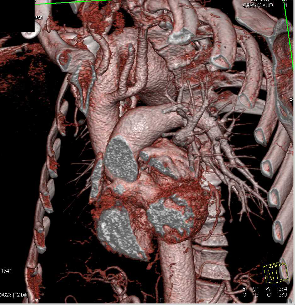 Right Sided Aortic Arch with Ductus Repair - CTisus CT Scan