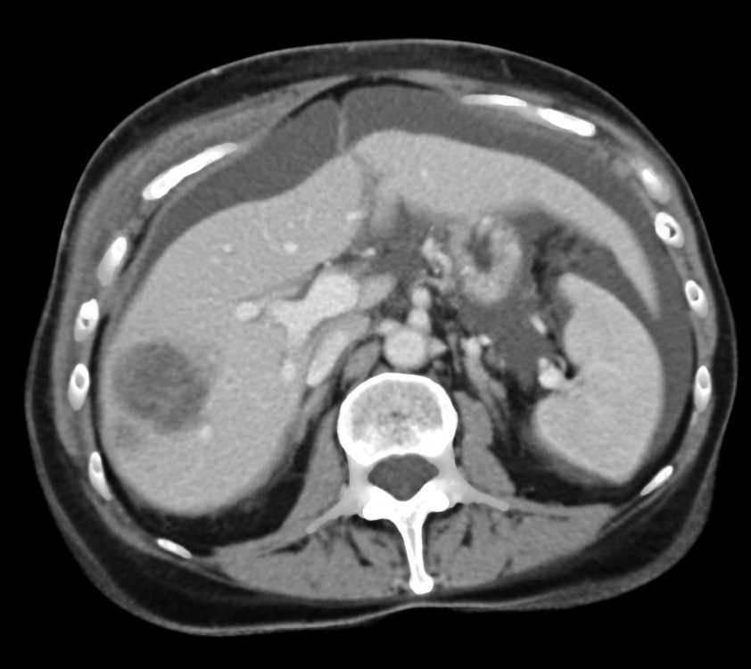 Incidental Pulmonary Embolism (PE) in a Patient with Pancreatic Cancer with Metastases - CTisus CT Scan
