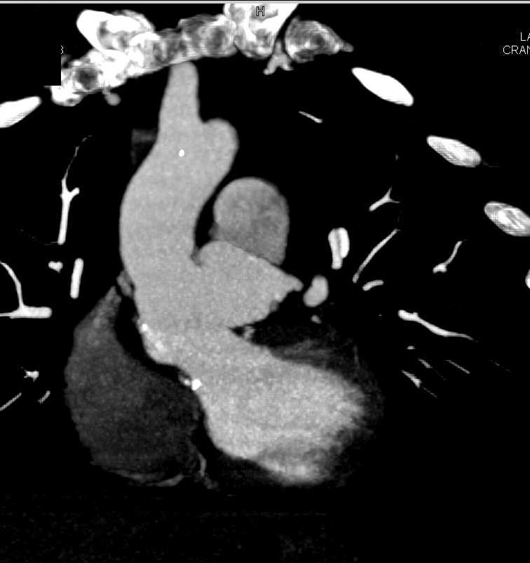 Pseudoaneurysm off the Ascending Aorta - CTisus CT Scan