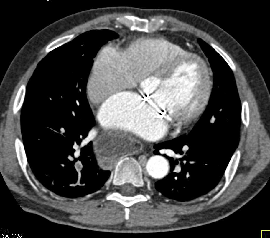 Multiple Pulmonary Enbolisn - CTisus CT Scan