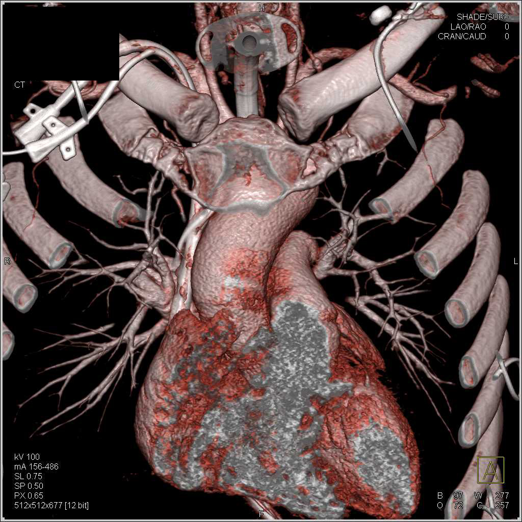 Aspiration Both Lower Lung Zones - CTisus CT Scan