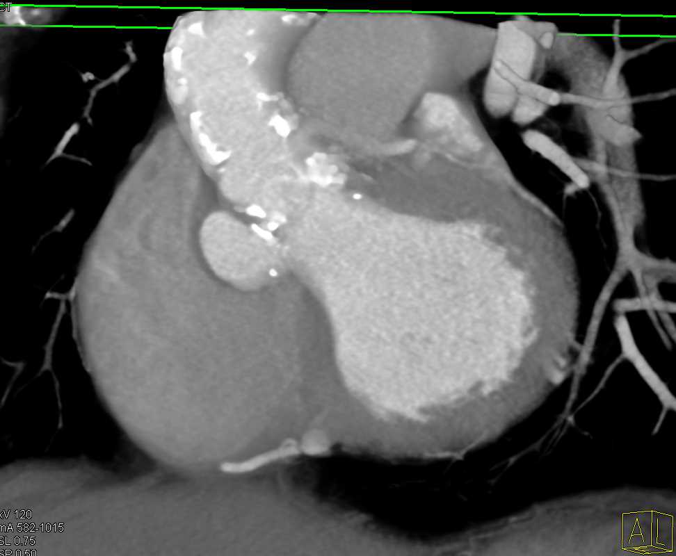 Pseudoaneurysm Aortic Root and Complex Cystic Pelvic Mass in Patient Pre-Transcatheter Aortic Valve Replacement (TAVR) - CTisus CT Scan