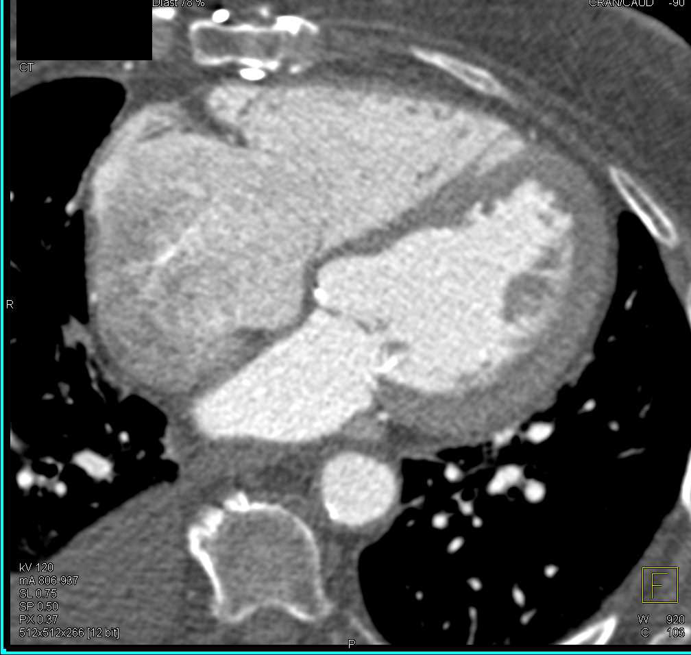 3D Map for Redo of Aortic Valve Replacement (AVR) with Mapping to Sternum - CTisus CT Scan