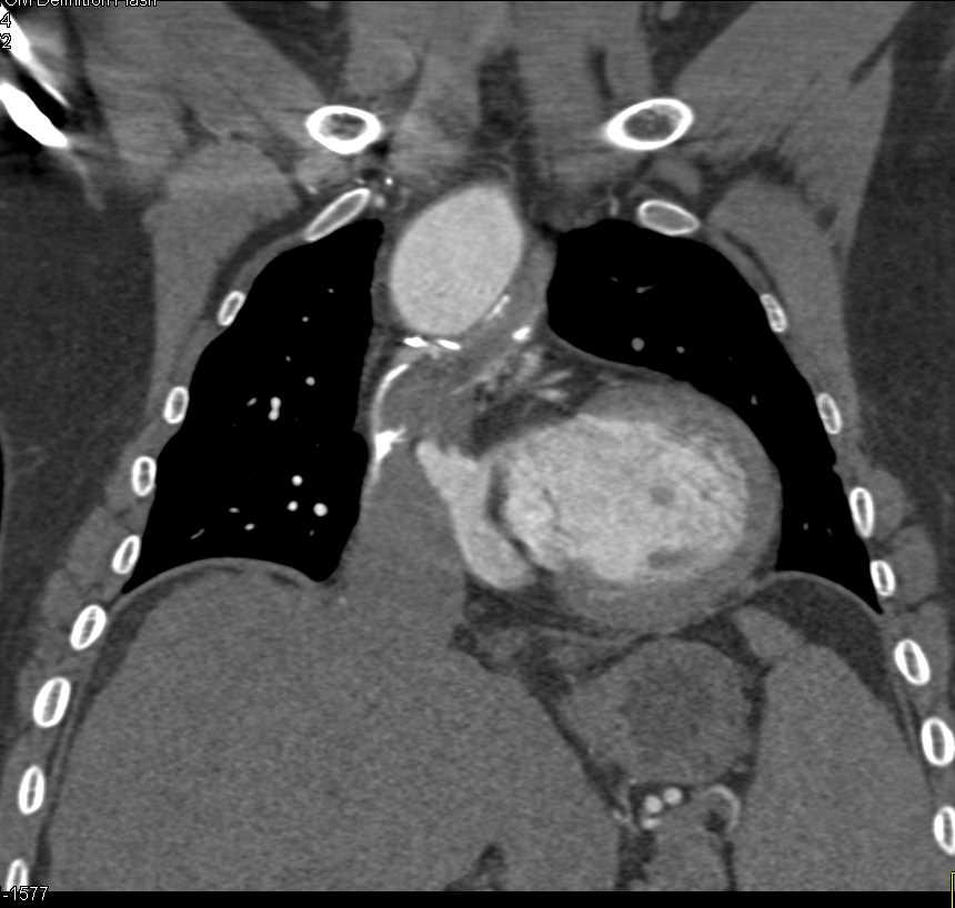 Arteriovenous (AV) Shunting and Pulmonary Embolism - CTisus CT Scan