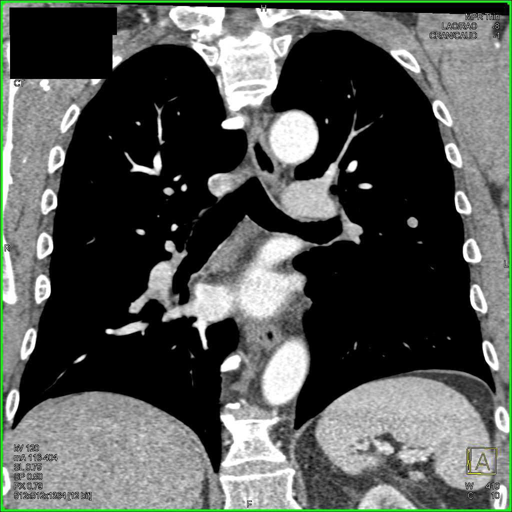 Subtle Pulmonary Embolism Left Upper Lobe - CTisus CT Scan