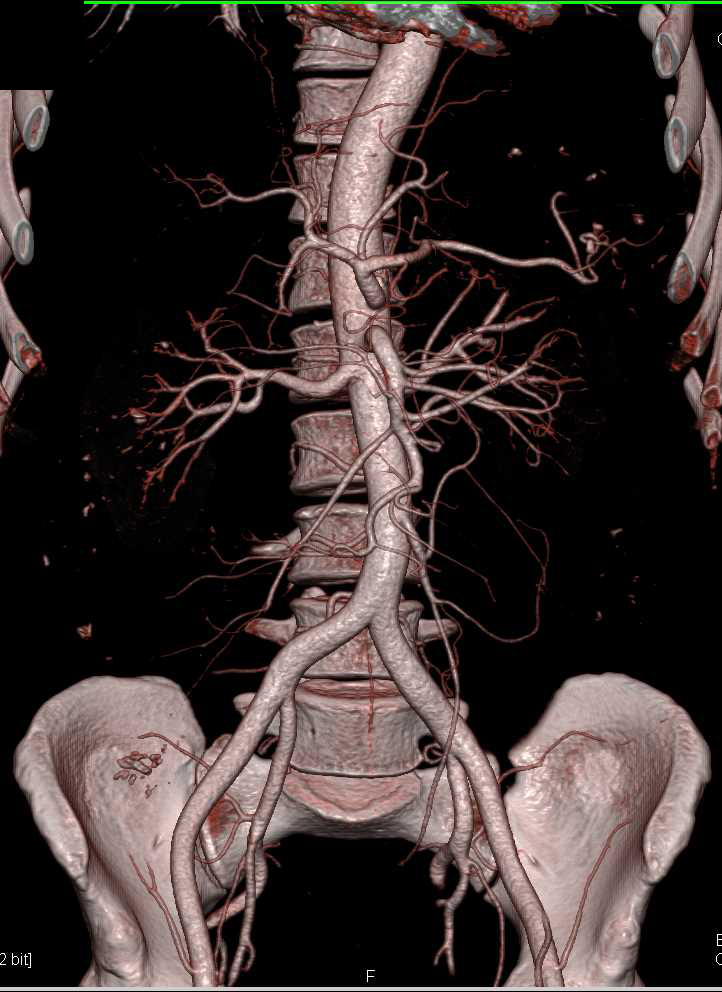 Gastric Cancer with Lymphangitic Spread to the Lungs - CTisus CT Scan