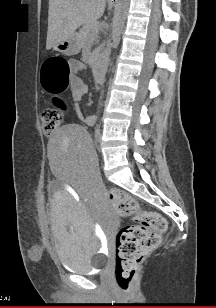 Hematoma in Right Breast and in Bladder - CTisus CT Scan