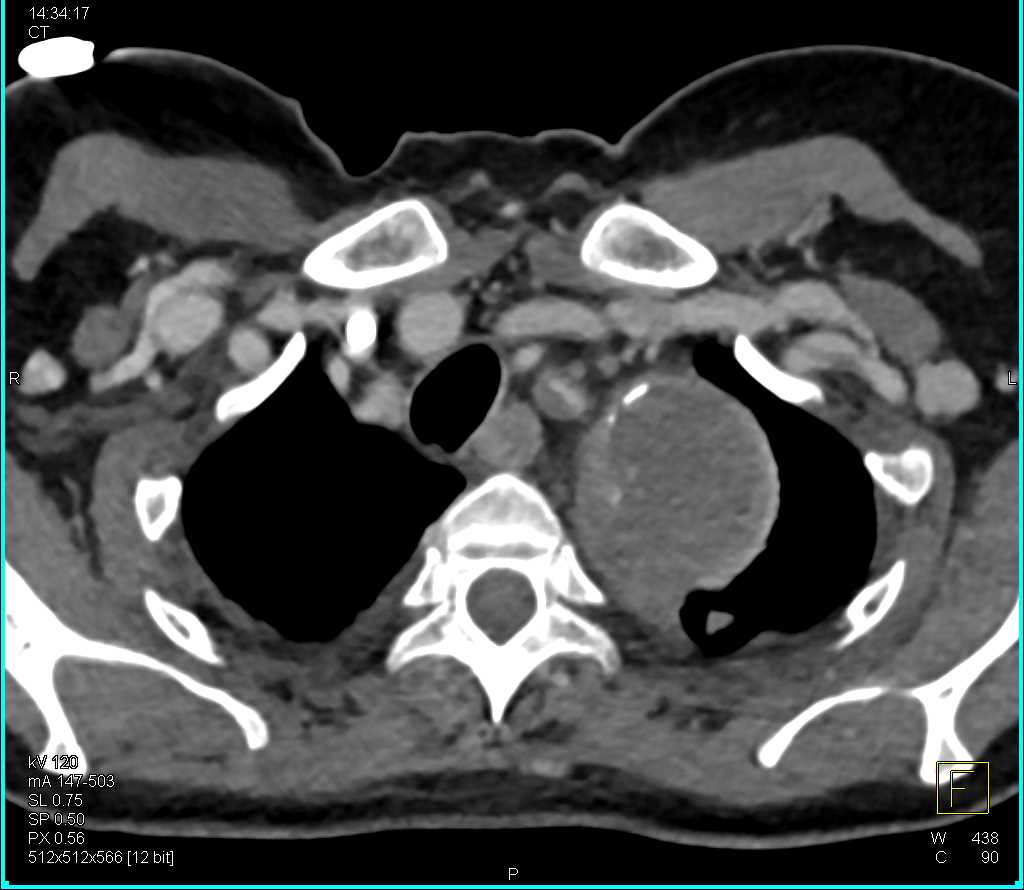 Type B Dissection with Stent - CTisus CT Scan