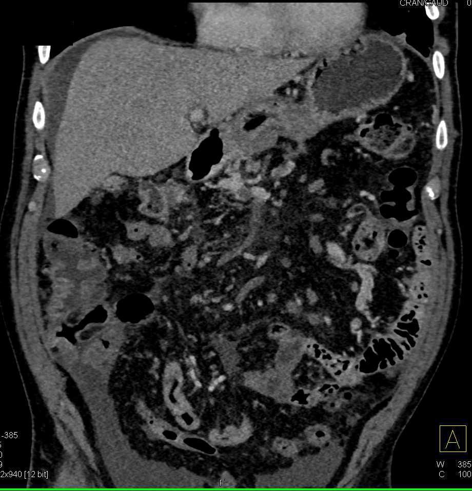 Incidental Pulmonary Embolism with Carcinomatosis - CTisus CT Scan