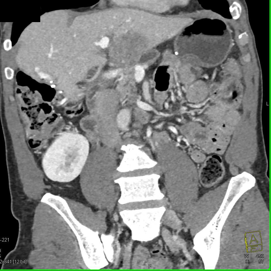 Pancreatic Cancer Obstructs the Pancreatic Duct and Liver Metastases - CTisus CT Scan